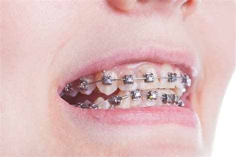 5 Types of Braces (Procedures, Costs & FAQs) .